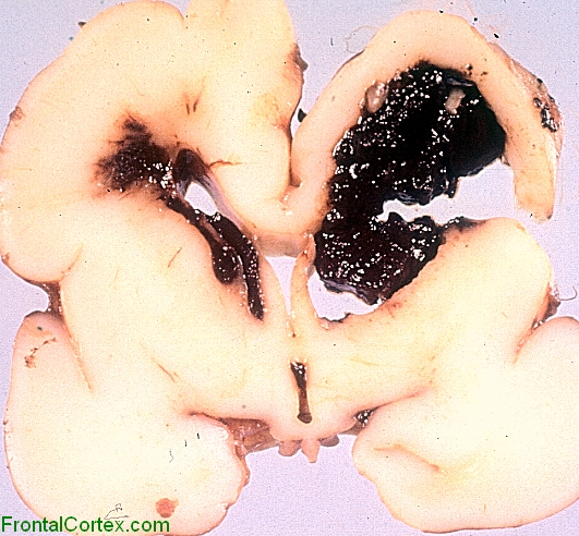 Periventricular hemorrhagic infarct and contralateral hydrocephalus, coronal section of brain